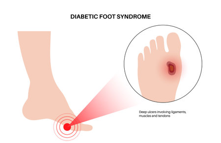 Diabetic Foot Ulcersのイラスト素材