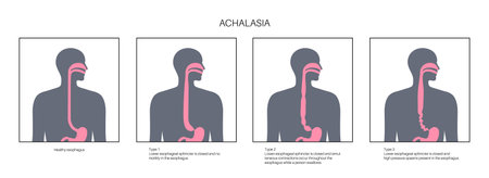 Esophageal achalasia diseaseのイラスト素材