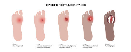 Diabetic Foot Ulcersのイラスト素材