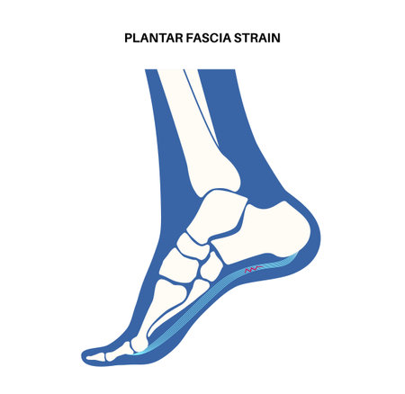Plantar fascia strainのイラスト素材