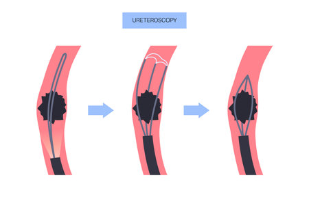 Ureteroscopy medical posterのイラスト素材