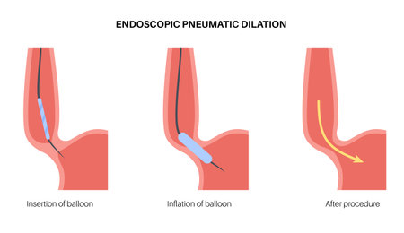 Endoscopic pneumatic dilationのイラスト素材