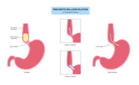 Endoscopic pneumatic dilationのイラスト素材