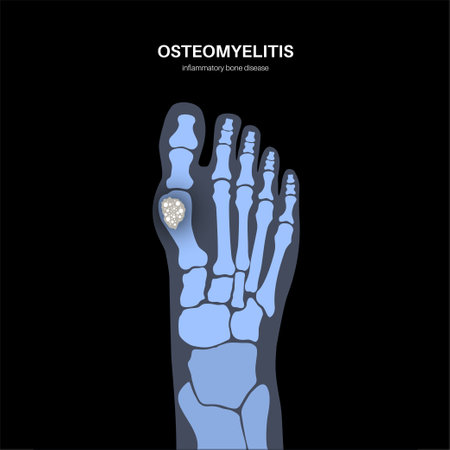 Osteomyelitis of feetのイラスト素材