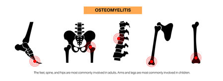 Osteomyelitis disease posterのイラスト素材