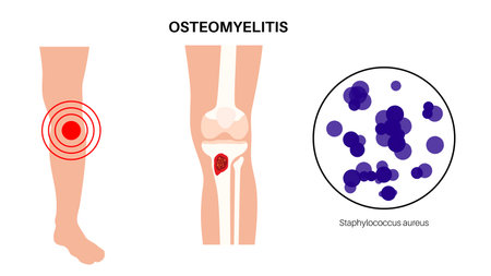 Tibia bone osteomyelitisのイラスト素材