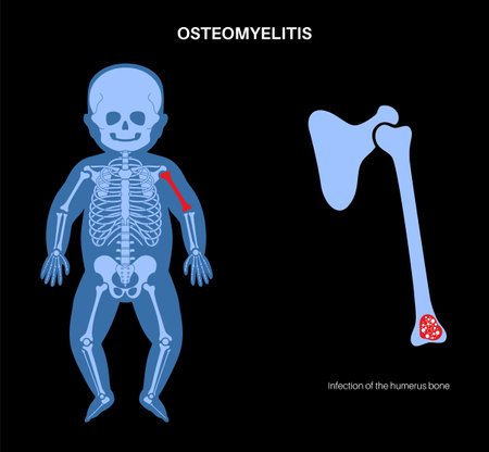 Osteomyelitis in childrenのイラスト素材
