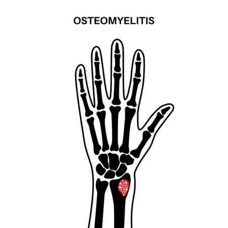 Osteomyelitis of armのイラスト素材