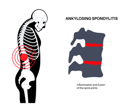 Ankylosing spondylitis diseaseのイラスト素材