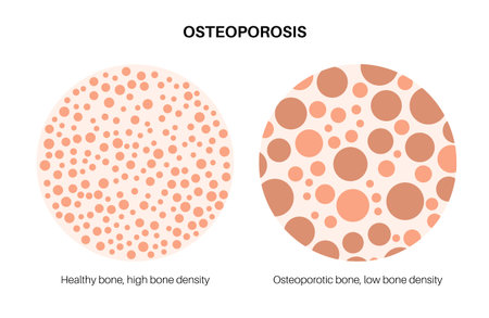 Osteoporosis medical posterのイラスト素材