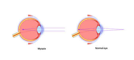 Normal eye and nearsightednessのイラスト素材