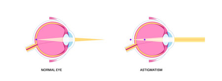 Astigmatism eye diseaseのイラスト素材
