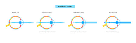 Refractive errors posterのイラスト素材