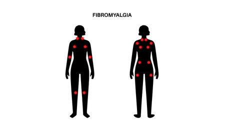Fibromyalgia medical posterのイラスト素材
