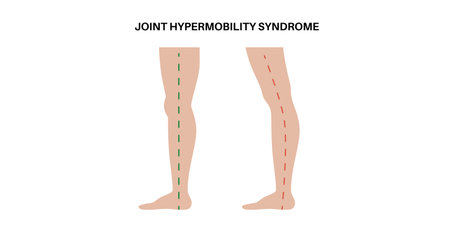 Joint hypermobility posterのイラスト素材