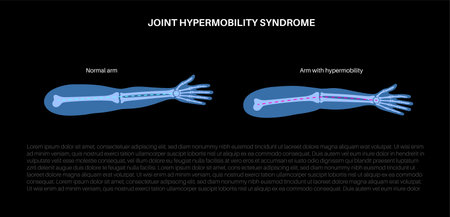 Joint hypermobility posterのイラスト素材