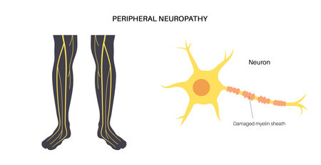 Peripheral neuropathy medical posterのイラスト素材