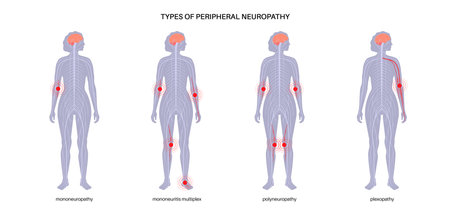 Peripheral neuropathy medical posterのイラスト素材