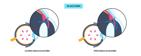 Glaucoma eye diseaseのイラスト素材