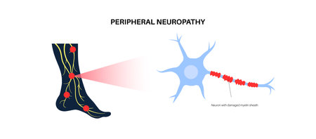 Peripheral neuropathy medical posterのイラスト素材