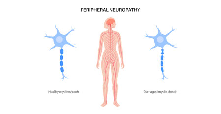 Peripheral neuropathy medical posterのイラスト素材