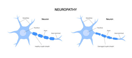 Peripheral neuropathy medical posterのイラスト素材