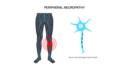 Peripheral neuropathy medical posterのイラスト素材