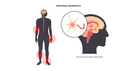 Peripheral neuropathy medical posterのイラスト素材