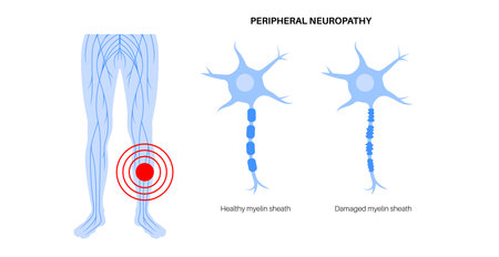 Peripheral neuropathy medical posterのイラスト素材