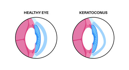 Cataract eye diseaseのイラスト素材