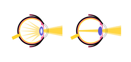 Cataract eye diseaseのイラスト素材