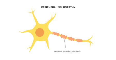 Peripheral neuropathy medical posterのイラスト素材
