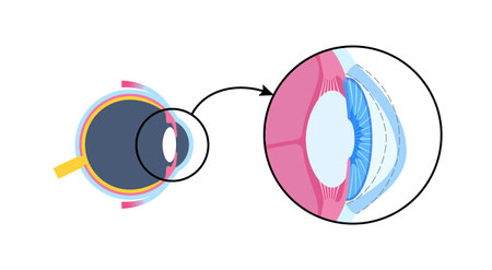 Cataract eye diseaseのイラスト素材
