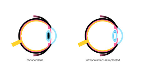 Intraocular lenses posterのイラスト素材