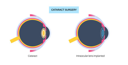 Intraocular lenses posterのイラスト素材