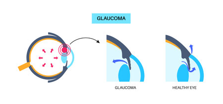 Glaucoma eye diseaseのイラスト素材