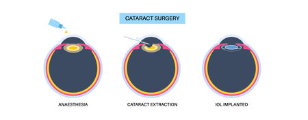 Cataract surgery posterのイラスト素材