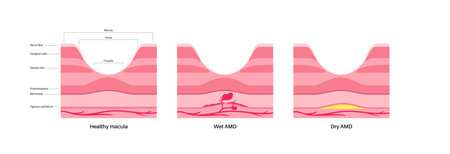 Macular degeneration posterのイラスト素材