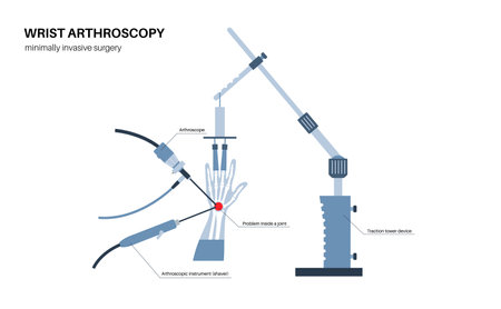 Wrist arthroscopy surgeryのイラスト素材
