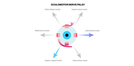 Oculomotor nerve palsyのイラスト素材