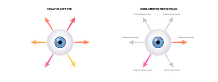 Oculomotor nerve palsyのイラスト素材