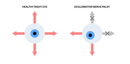 Oculomotor nerve palsyのイラスト素材