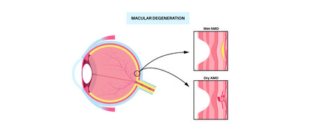 Macular degeneration posterのイラスト素材
