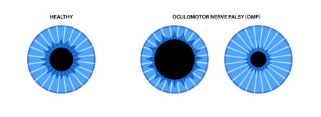 Oculomotor nerve palsyのイラスト素材