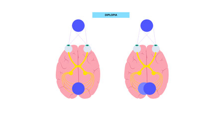 Diplopia medical posterのイラスト素材