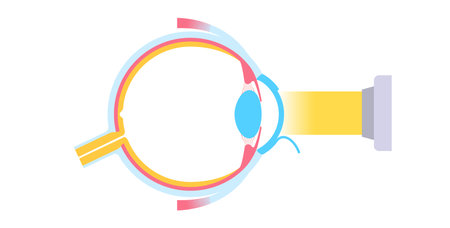 Lasik eye surgeryのイラスト素材