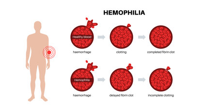 Hemophilia medical posterのイラスト素材