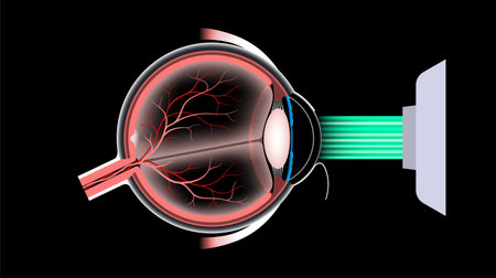 LASIK eye surgeryのイラスト素材