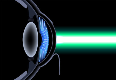LASIK eye surgeryのイラスト素材