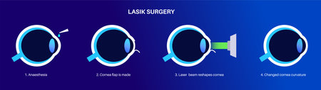LASIK eye surgeryのイラスト素材